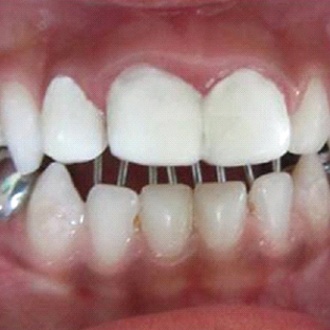 Closeup of a patient wearing a tongue crib in Rutland