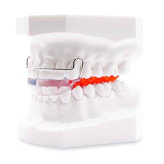 White model jaw and teeth displaying a Bionator in Rutland