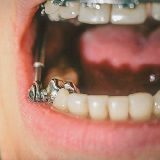 Closeup of a patient wearing a Herbst appliance in Rutland