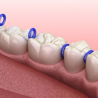 Diagram of dental spacers in Rutland dental separators in Rutland