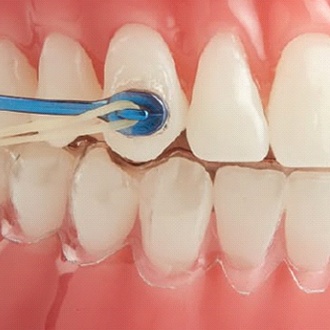 Closeup of patient wearing a Carriere appliance in Rutland