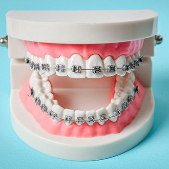 Traditional braces on model of teeth with blue background