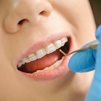 Dentist placing clear and ceramic braces
