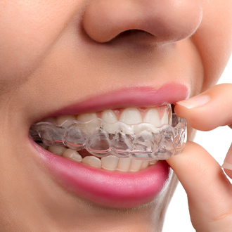 Closeup of patient placing Invisalign tray