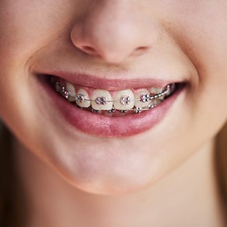 Closeup of braces after visiting Rutland orthodontist 