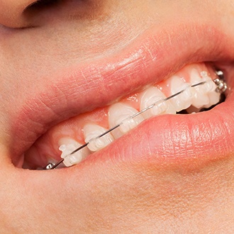 Closeup of loose braces that need treatment from Rutland orthodontist 