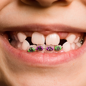 Closeup of smile with phase one pediatric orthodontic appliance in place