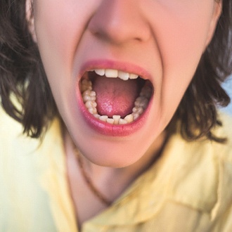 An up-close image of a person’s crowded teeth on the lower arch