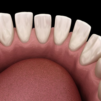 A digital image of the lower row of teeth that appear to be spaced far apart