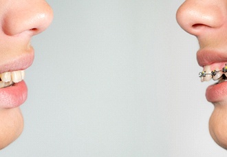 The side view of a person’s teeth who has an overbite but is wearing braces to fix the problem