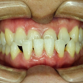 An up-close view of a person’s smile who has an underbite