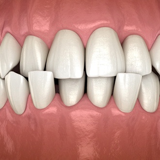 The digital image of a crossbite with the teeth overlapping