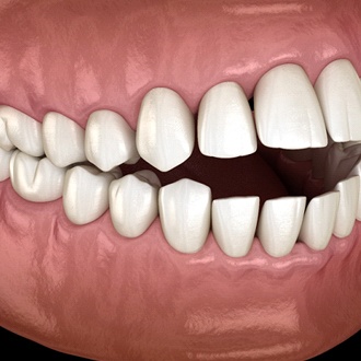 A digital image of an open bite with the back teeth touch and the front teeth apart