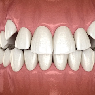 A digital image of impacted canine teeth