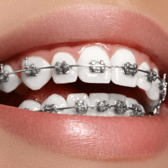 Closeup of smile with self-ligating braces