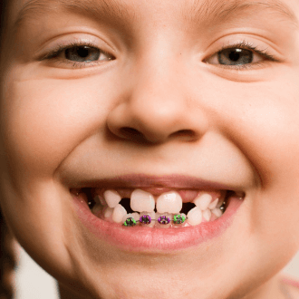 Child's smile with pediatric orthodontics visible on bottom teeth