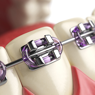 Animated smile with traditional braces